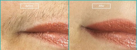 Upper Lip Laser Hair Removal: Complete Q&As (3)