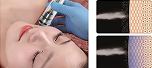 Portable Oxygen Facial Machine For Home Use | PrettyLasers (7) Portable Oxygen Facial Machine For Home Use | PrettyLasers (7)