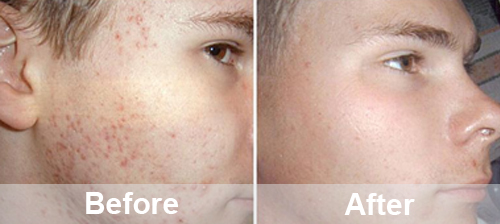 Portable Oxygen Facial Machine For Home Use | PrettyLasers (18) Portable Oxygen Facial Machine For Home Use | PrettyLasers (18)