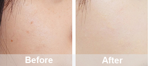 Portable Oxygen Facial Machine For Home Use | PrettyLasers (21) Portable Oxygen Facial Machine For Home Use | PrettyLasers (21)