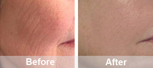 Portable Oxygen Facial Machine For Home Use | PrettyLasers (19) Portable Oxygen Facial Machine For Home Use | PrettyLasers (19)