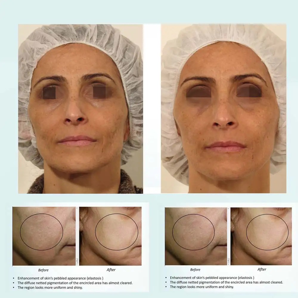 Best Professional Oxygen Facial Machine (1) Best Professional Oxygen Facial Machine (1)